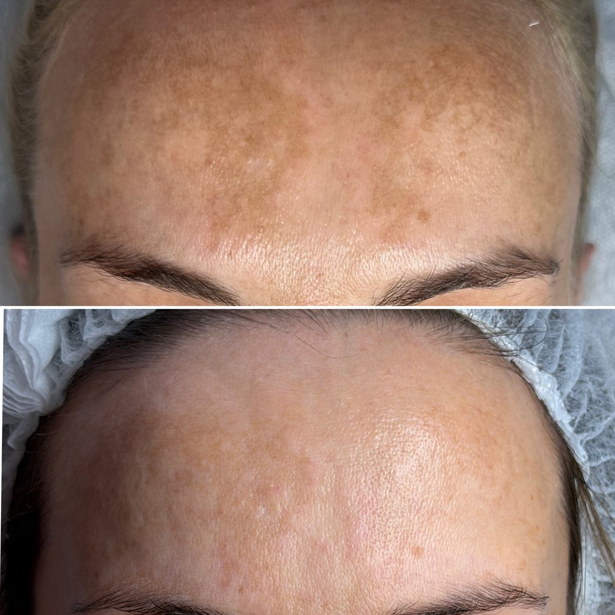 Efekt zabiegu Dermapen 4.0 — skóra przed i po